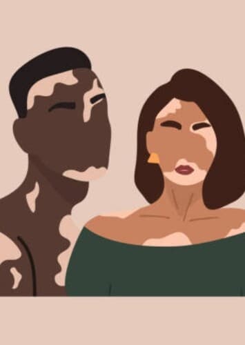 Vitiligo