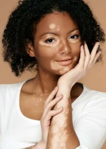 Vitiligo